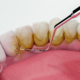 teeth scaling and polishing
